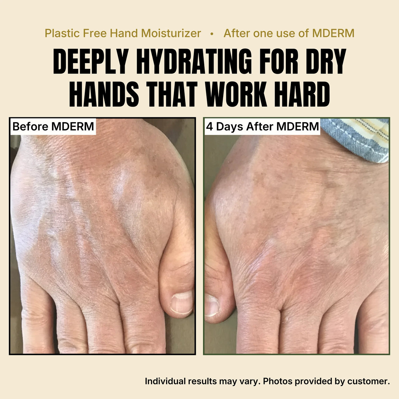 Two photos of the back of the same hand. Before MDERM, the skin looks dry and flaky. Four days after using MDERM, the skin looks smoother and more hydrated. Individual results may vary; photos provided by a customer.