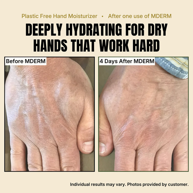 Two photos of the back of the same hand. Before MDERM, the skin looks dry and flaky. Four days after using MDERM, the skin looks smoother and more hydrated. Individual results may vary; photos provided by a customer.